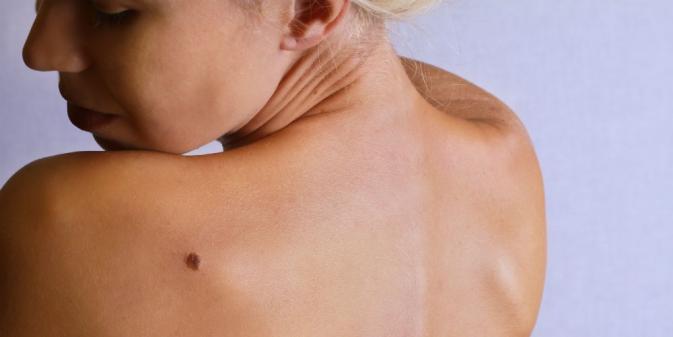 woman with a mole on back