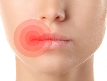 House Call Doctor What Is A Cold Sore Quick And Dirty Tips
